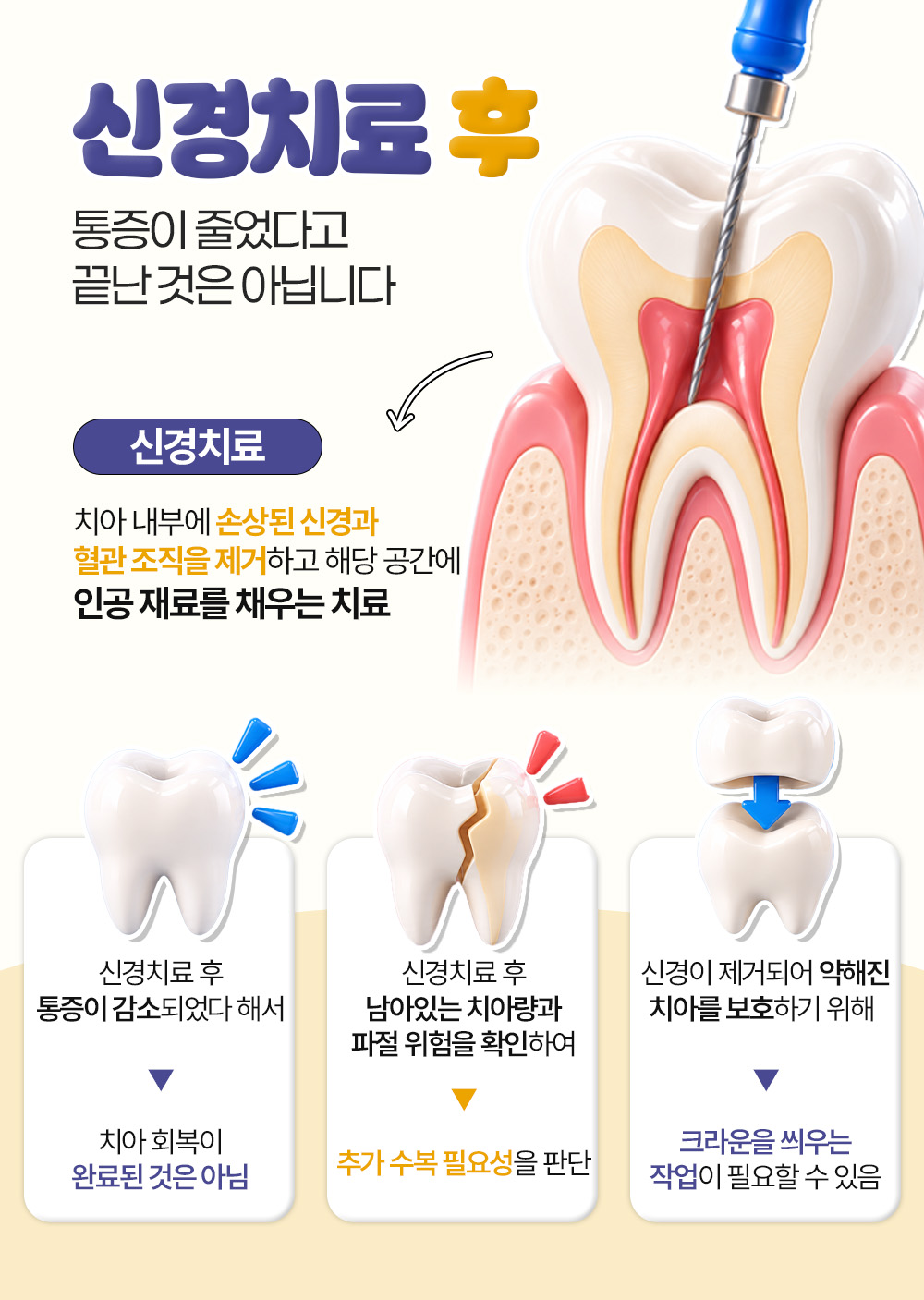 신경치료의 뜻을 풀고 통증이 줄어도 회복이 끝난 것은 아니라는 세 칸 설명