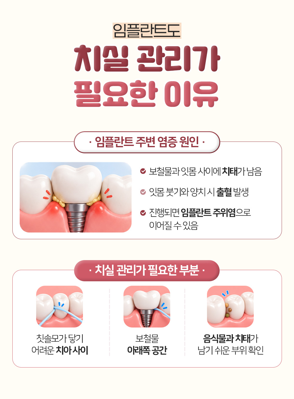 보철물과 잇몸 사이 치태와 출혈이 주위염으로 이어질 수 있다는 염증 원인과 치아 사이, 보철물 아래 등 치실이 필요한 부분