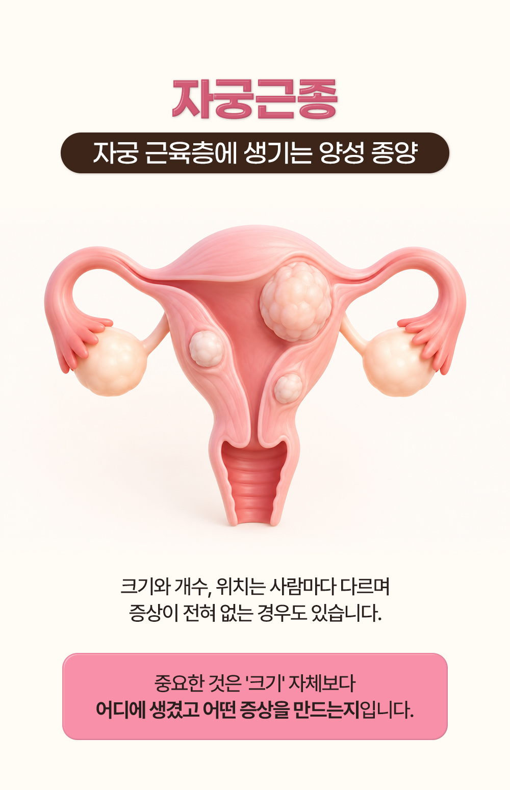 자궁 근육층에 생기는 양성 종양이라는 뜻과 크기보다 위치와 증상이 중요하다는 설명