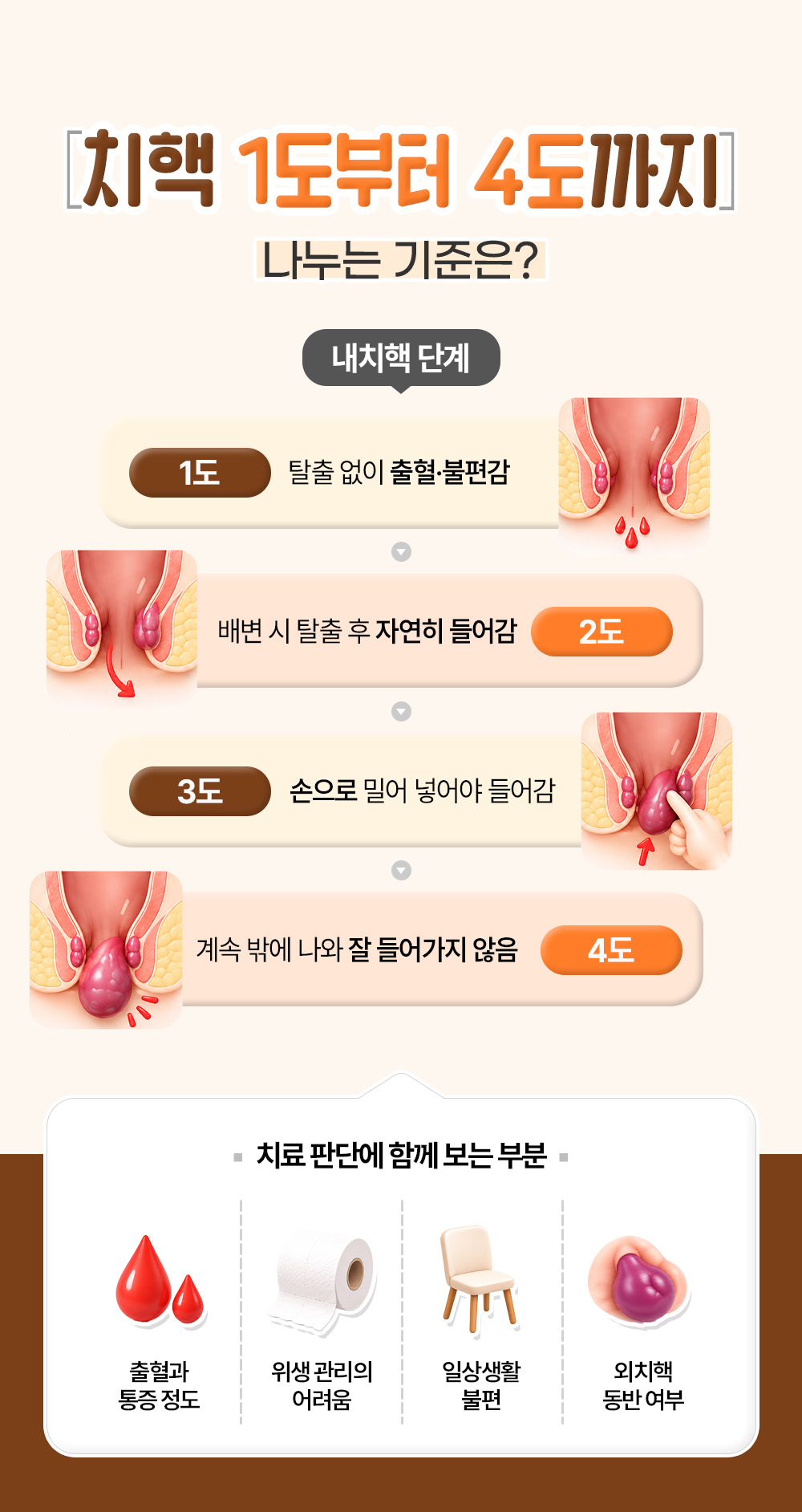 탈출 여부로 나눈 내치핵 1도부터 4도와 치료 판단에 함께 보는 네 가지